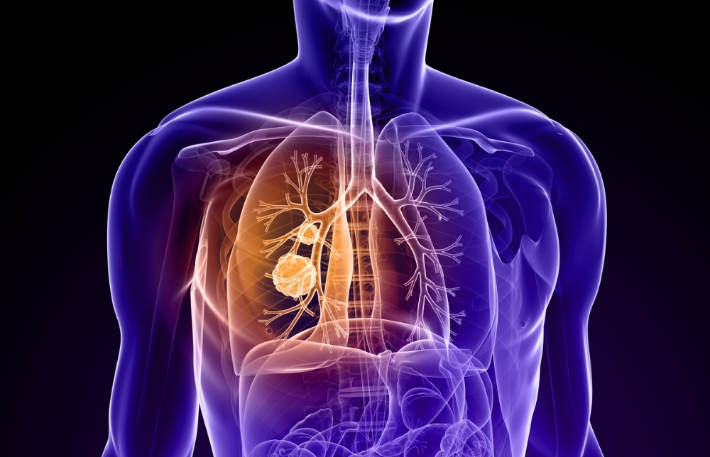 Do You Know the Warning Signs of Lung Cancer? Image